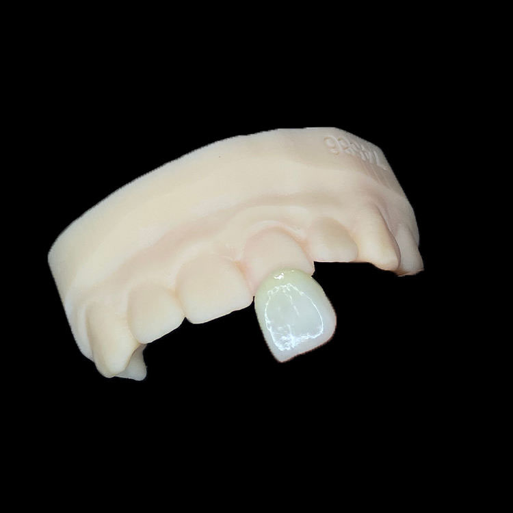 Veneers