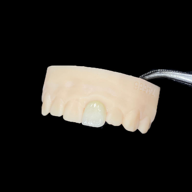 E.max, zirconia o feldspatico per le faccette anteriori? Una guida alla scelta basata sul caso 1 Faccette