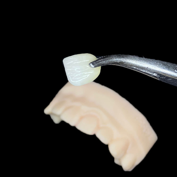 E.max, zirconia o feldspatico per le faccette anteriori? Una guida alla scelta basata sul caso 2 Faccette