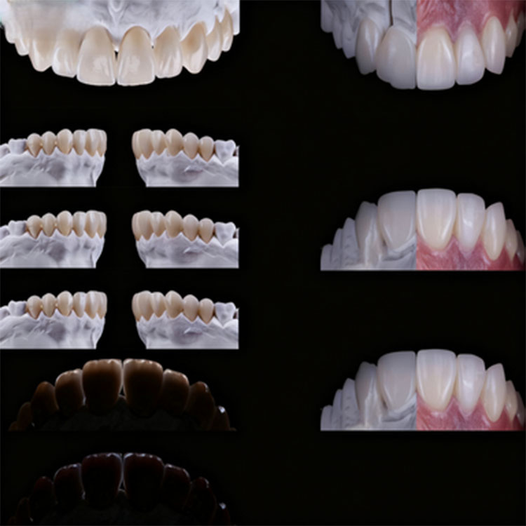 What Is the Most Efficient Cementation Sequence for Multiple Veneers? 2 What Is the Most Efficient Cementation Sequence for Multiple Veneers
