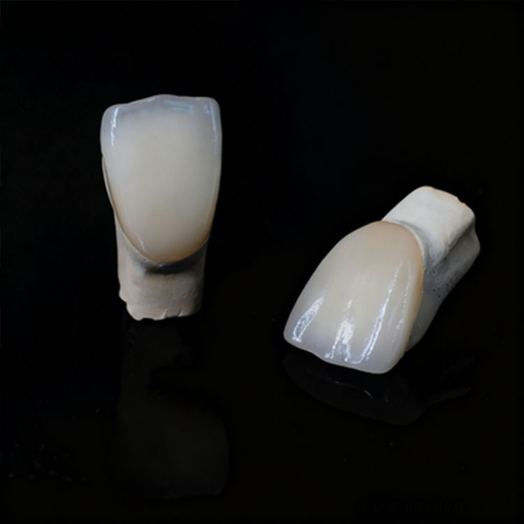 What Is the Most Efficient Cementation Sequence for Multiple Veneers? 3 What Is the Most Efficient Cementation Sequence for Multiple Veneers