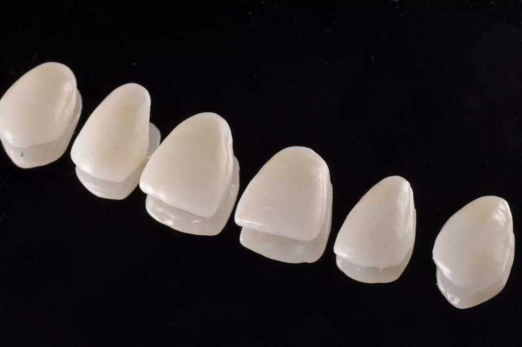 What Value Do Layered E.max Veneers Bring to Premium Smile Makeovers? 3 What Value Do Layered E.max Veneers Bring to Premium Smile Makeovers