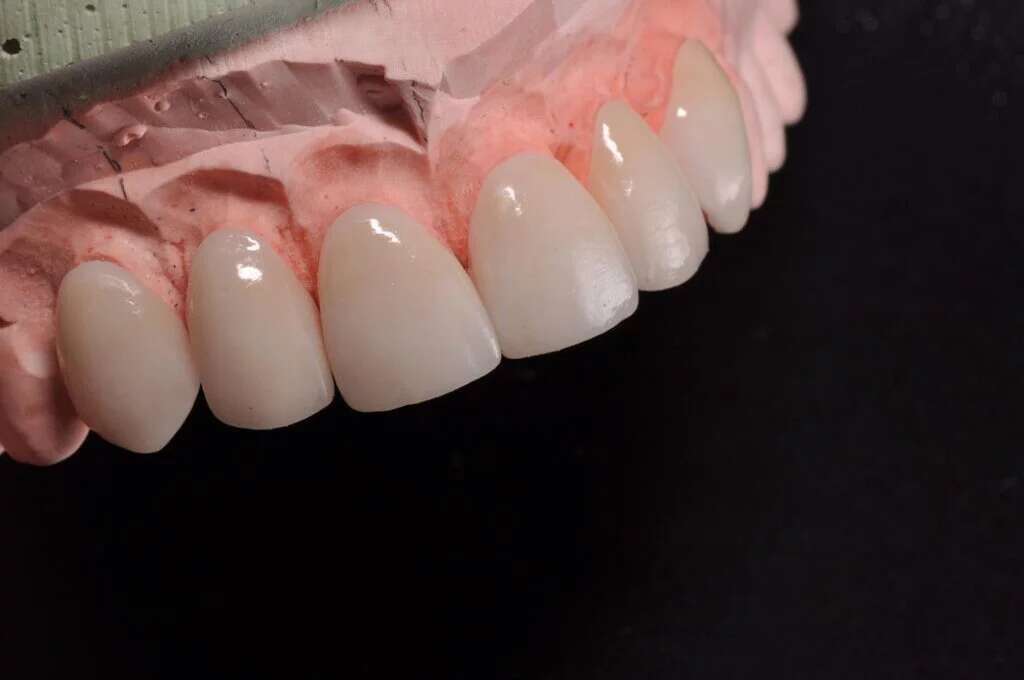What Value Do Layered E.max Veneers Bring to Premium Smile Makeovers