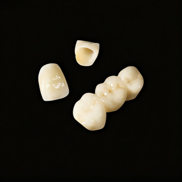 Where Is the Indication Boundary Between E.max Veneers and E.max Crowns? 1 Where Is the Indication Boundary Between E.max Veneers and E.max Crowns