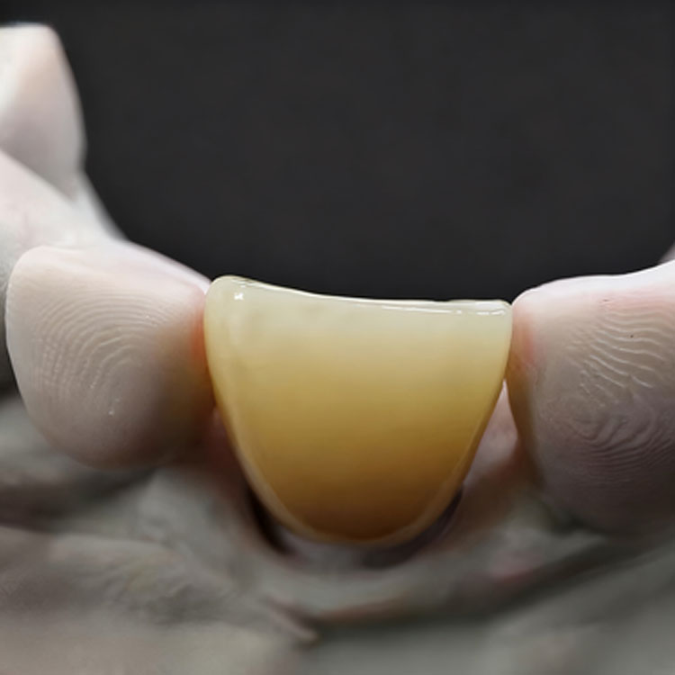 Where Is the Indication Boundary Between E.max Veneers and E.max Crowns? 2 Where Is the Indication Boundary Between E.max Veneers and E.max Crowns