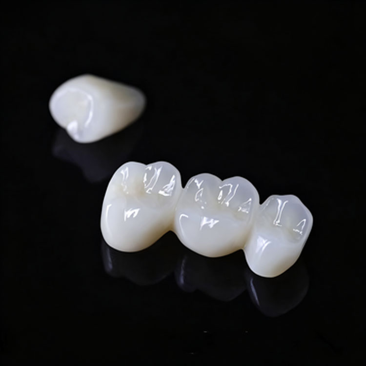 Where Is the Indication Boundary Between E.max Veneers and E.max Crowns? 3 Where Is the Indication Boundary Between E.max Veneers and E.max Crowns