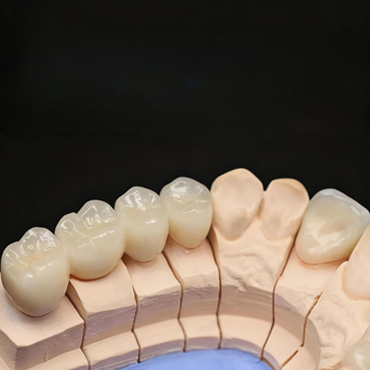 Where Is the Indication Boundary Between E.max Veneers and E.max Crowns