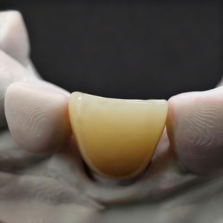 Which Smile Makeover Cases Are Better Suited to Feldspathic Rather Than E.max