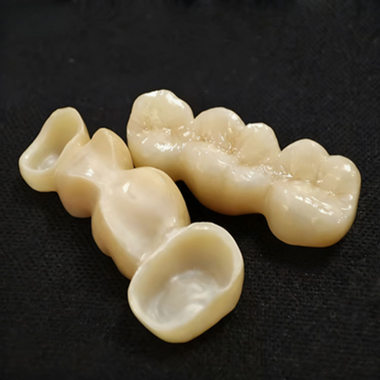Which Smile Makeover Cases Are Better Suited to Feldspathic Rather Than E.max? 2 Which Smile Makeover Cases Are Better Suited to Feldspathic Rather Than E.max