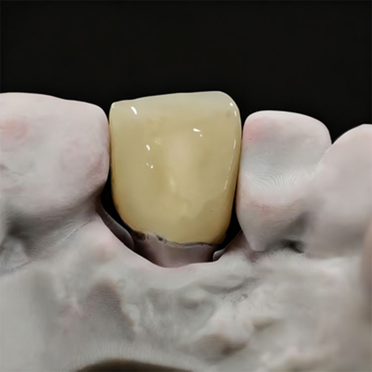Which Smile Makeover Cases Are Better Suited to Feldspathic Rather Than E.max? 3 Which Smile Makeover Cases Are Better Suited to Feldspathic Rather Than E.max