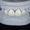 Anterior Zirconia Veneer