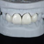 Anterior Zirconia Veneer