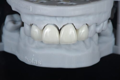 Anterior Zirconia Veneer