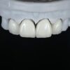 Anterior Zirconia Veneer