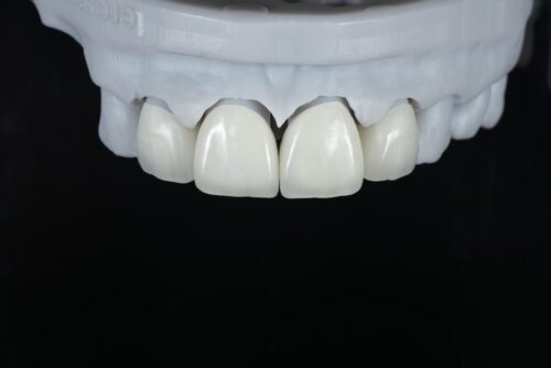 Anterior Zirconia Veneer