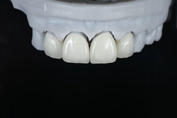 Anterior Zirconia Veneer