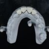 Anterior Zirconia Veneer
