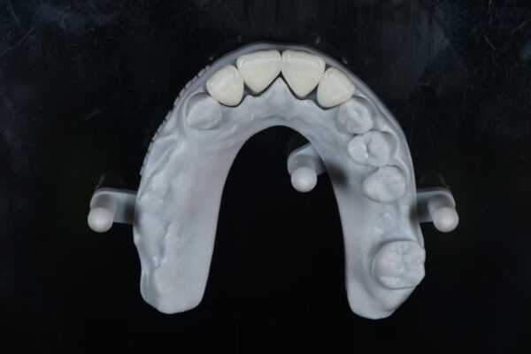 Anterior Zirconia Veneer
