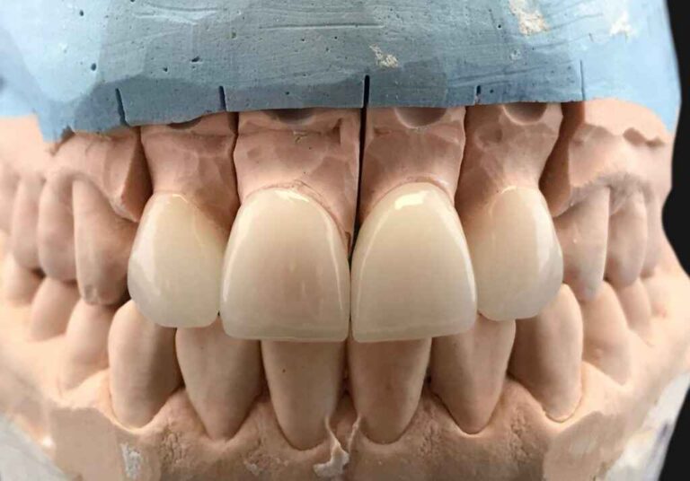 Are E.max Crowns Suitable for High-Occlusion Back Situations? 3 Are E.max Crowns Suitable for High-Occlusion Back Situations