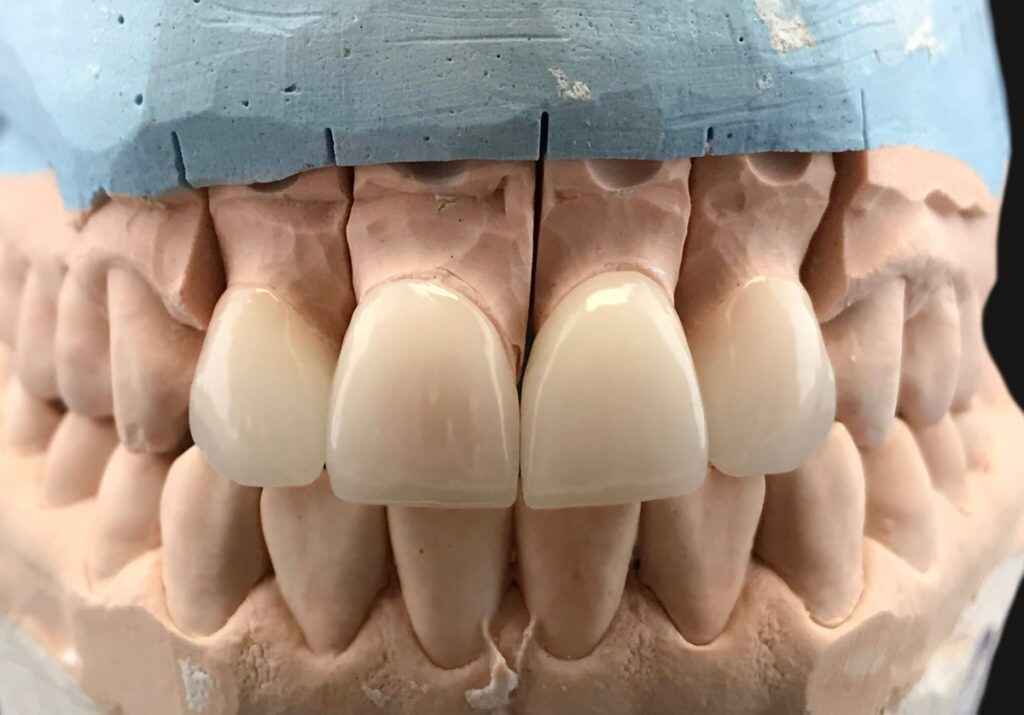 Are E.max Crowns Suitable for High-Occlusion Back Situations