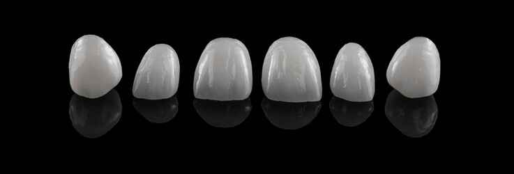 E.max Crowns vs Layered Zirconia Crowns: Comparing Esthetics, Strength, and Remake Risk 2 E.max Crowns