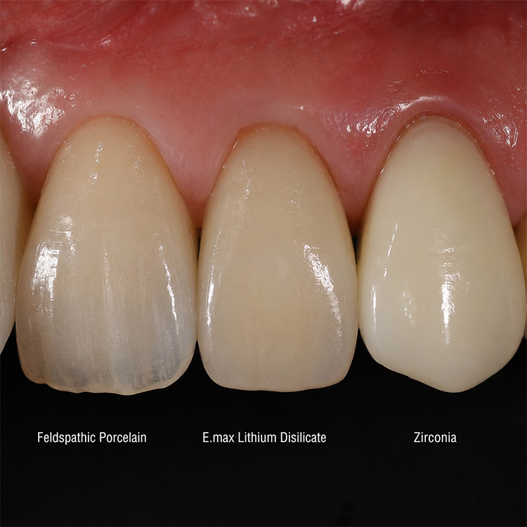 Feldspathic vs E.max vs Zirconia 4