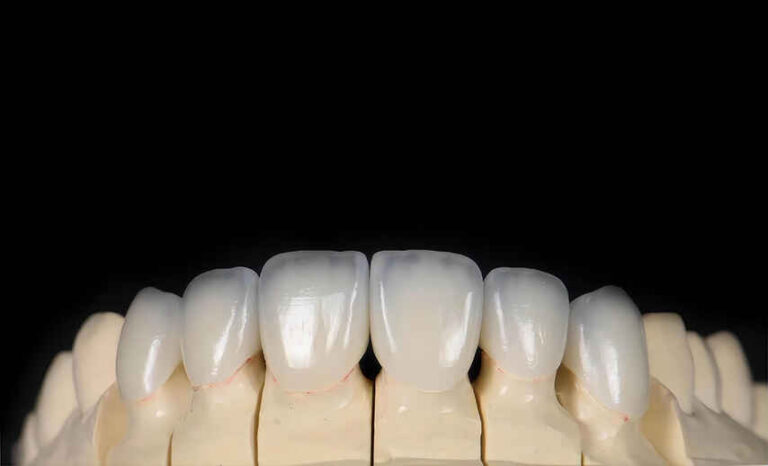 How to Provide Better Case Communication for Layered Zirconia Crowns 1