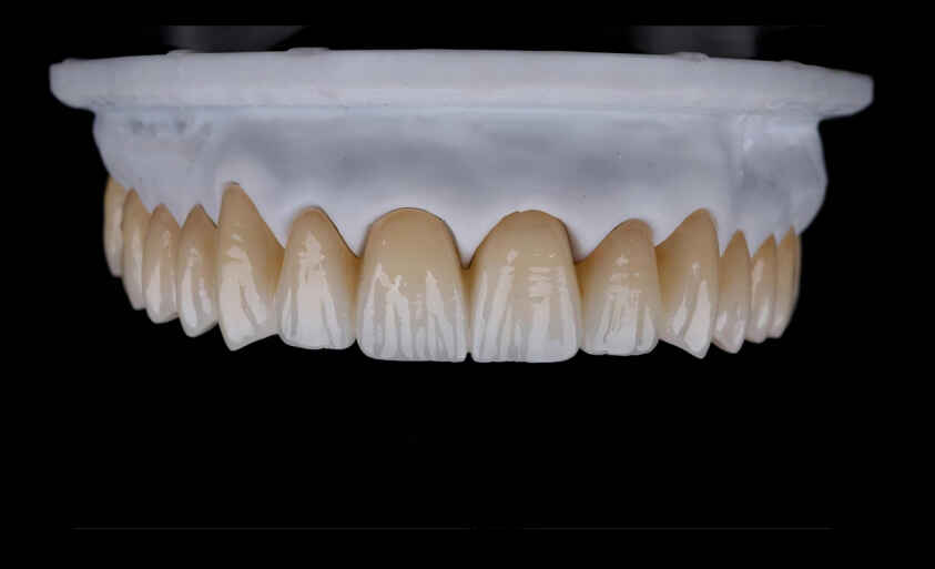 How to Provide Better Case Communication for Layered Zirconia Crowns 1 How to Provide Better Case Communication for Layered Zirconia Crowns 2
