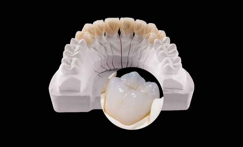 How to Provide Better Case Communication for Layered Zirconia Crowns 2 How to Provide Better Case Communication for Layered Zirconia Crowns 3