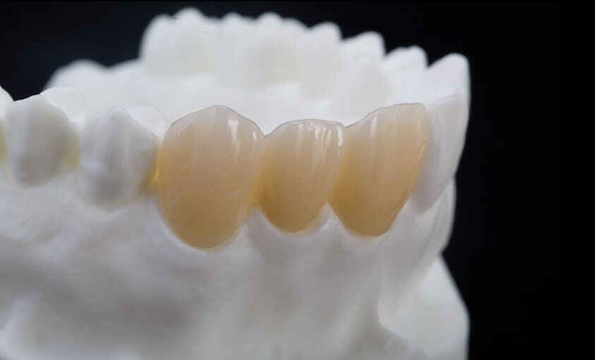 How to Provide Better Case Communication for Layered Zirconia Crowns 3 How to Provide Better Case Communication for Layered Zirconia Crowns 4