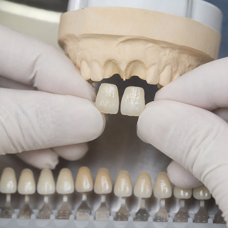 Is High-Translucency Zirconia Really Enough for Anterior Cases