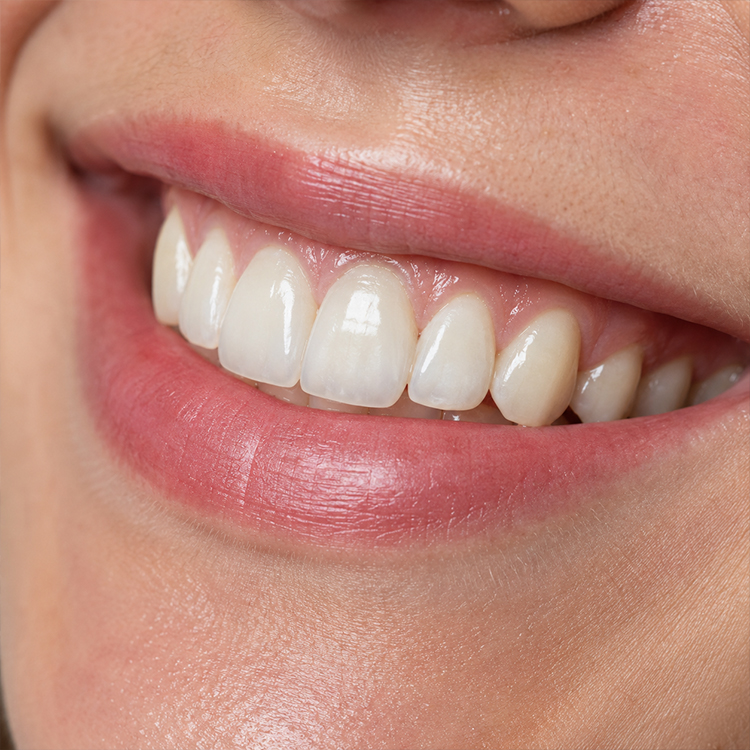 Is High-Translucency Zirconia Really Enough for Anterior Cases? 3 Is High-Translucency Zirconia Really Enough for Anterior Cases