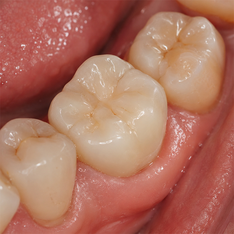 Multi-layer Zirconia