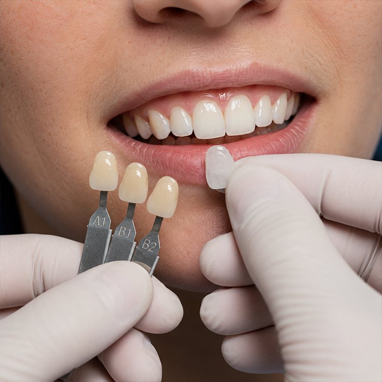 What Should Be Considered When Showing Veneer Cases for Expectation Management 3 Veneer