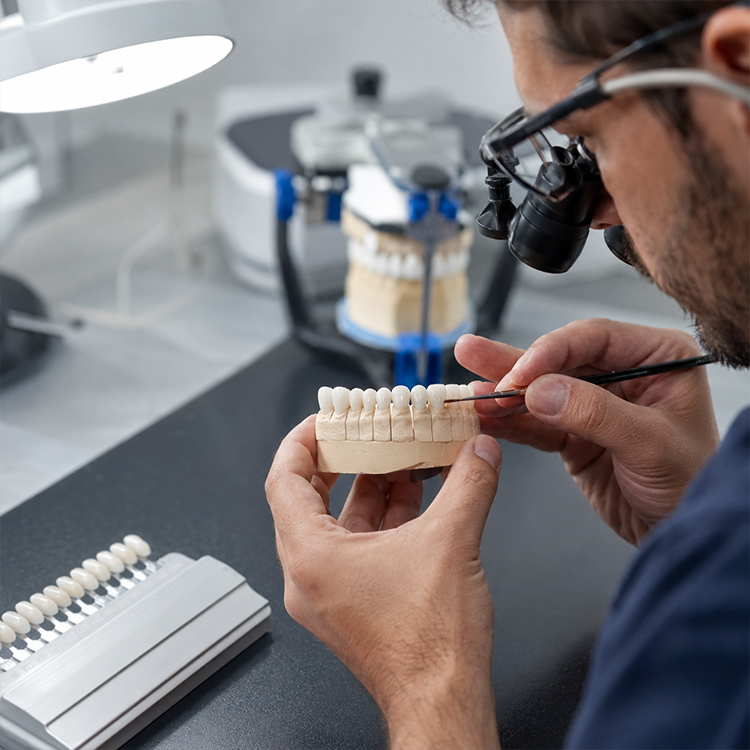Can Veneers Be Used Directly in Deep Bite or Edge-to-Edge Cases? 6 Veneers