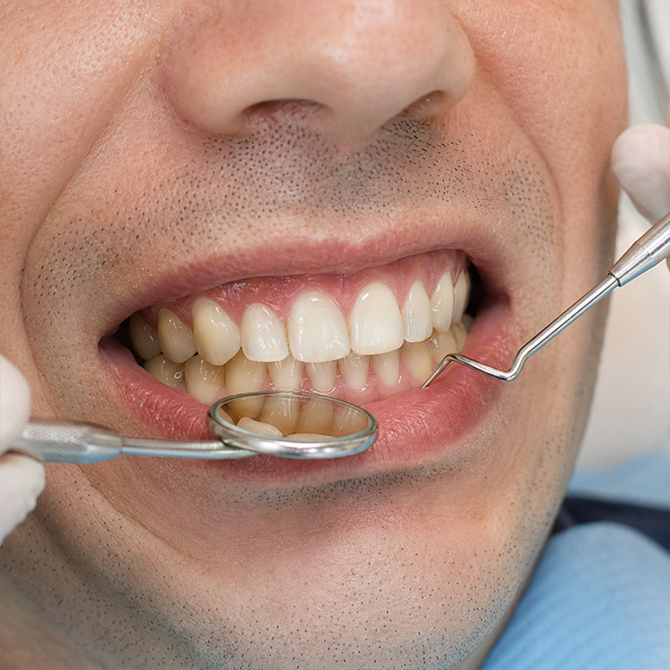 Can Veneers Be Used Directly in Deep Bite or Edge-to-Edge Cases? 1 Veneers