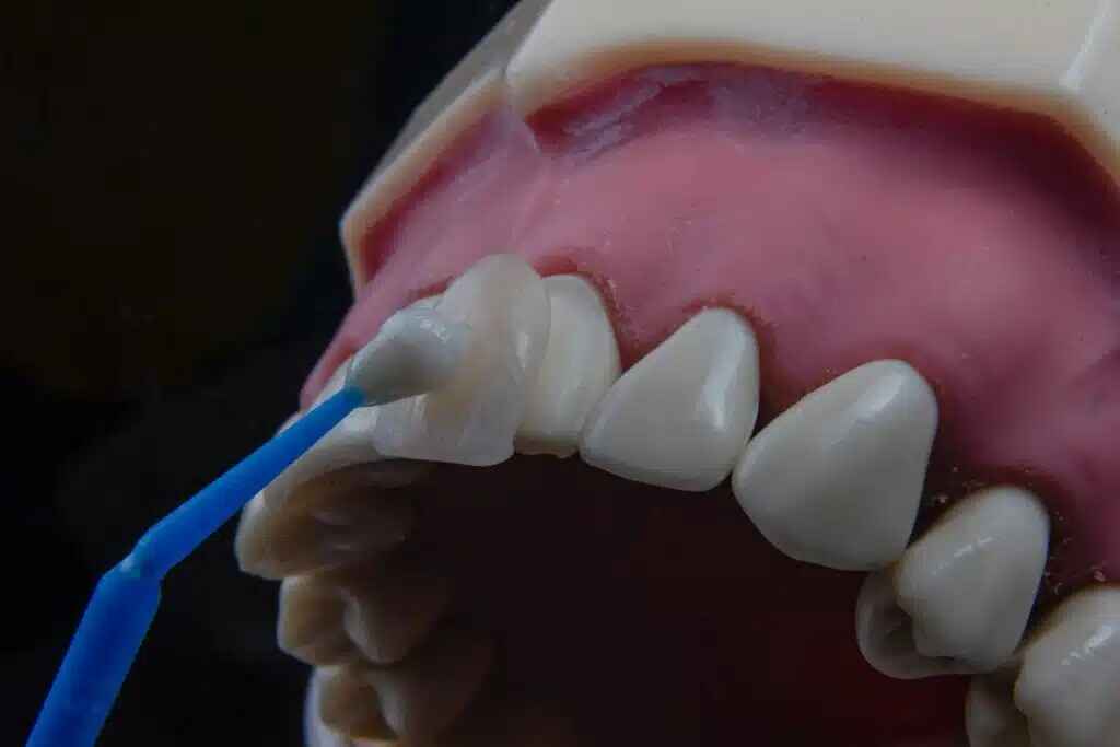 Zirconia Veneers