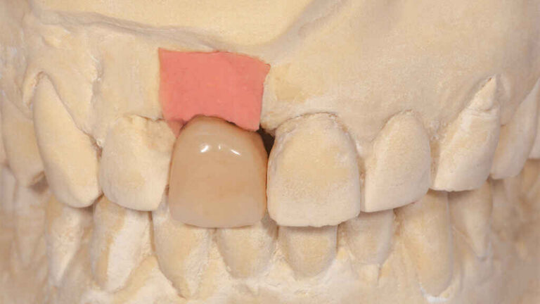Why Single Central Incisor Restorations Are the Hardest Anterior Cases 1 Anterior Cases