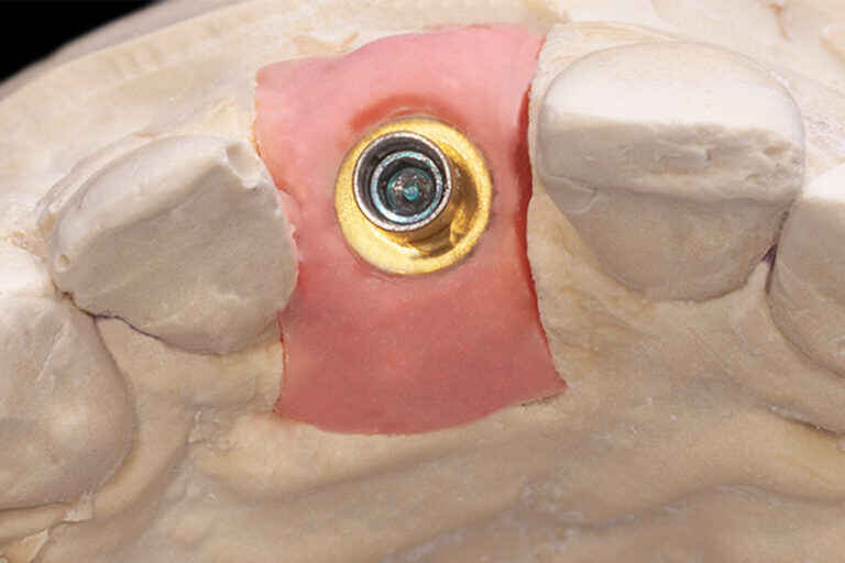 Why Single Central Incisor Restorations Are the Hardest Anterior Cases 1 Anterior Cases