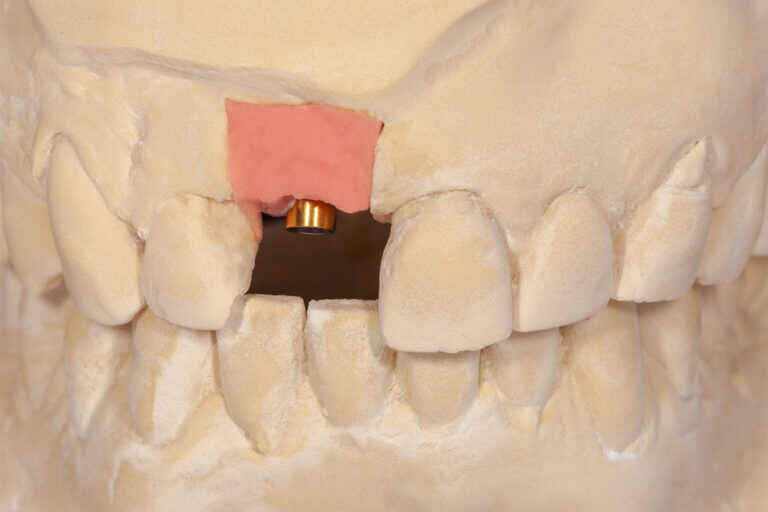 Why Single Central Incisor Restorations Are the Hardest Anterior Cases 3 Anterior Cases