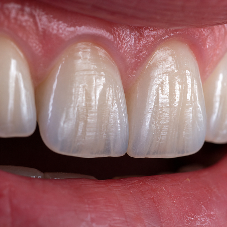 Why Surface Texture Determines Realism in Anterior Cases 5 Why Surface Texture Determines Realism in Anterior Cases