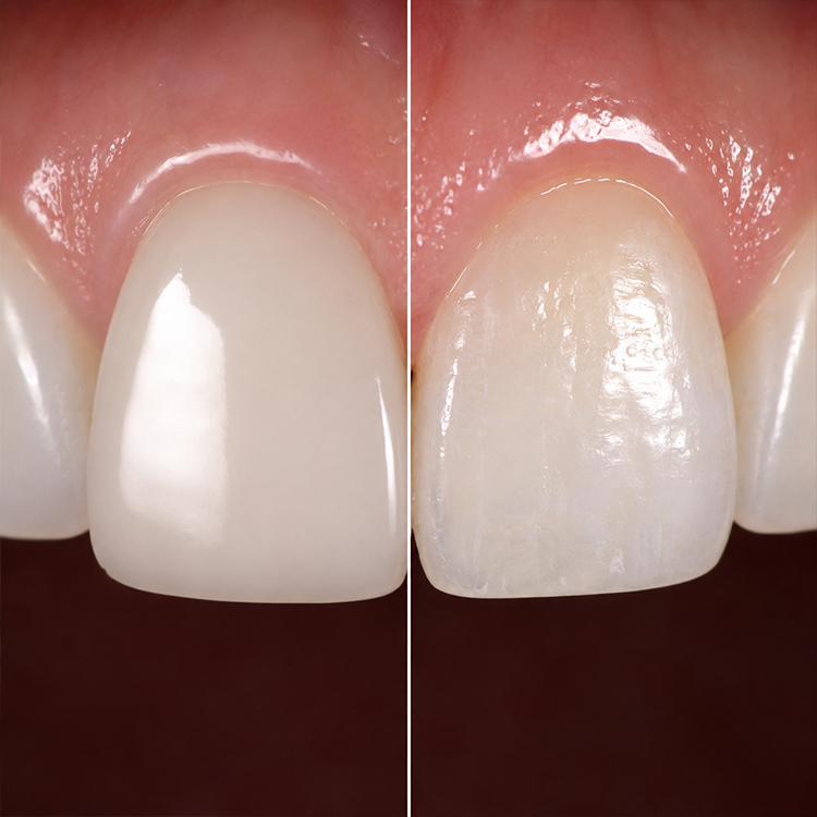 Why Surface Texture Determines Realism in Anterior Cases 1 Why Surface Texture Determines Realism in Anterior Cases