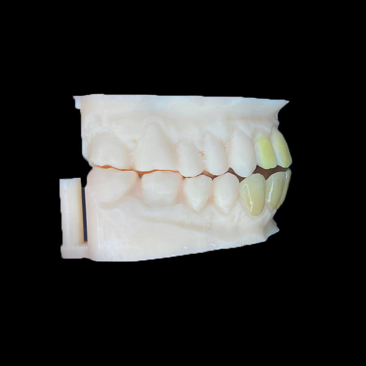 Are Zirconia Veneers Suitable for High-Smile-Line Cases? 2 Zirconia Veneers