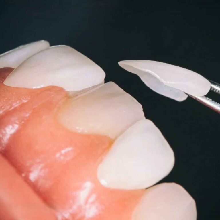 How Much Incisal Translucency Is Appropriate in Veneer Design