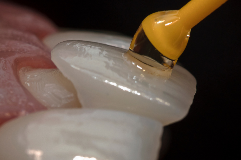 How Much Incisal Translucency Is Appropriate in Veneer Design