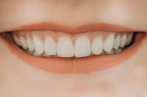 How Premium Labs Can Use Case Stories to Market High-End Anterior Restorations