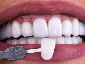 Veneer