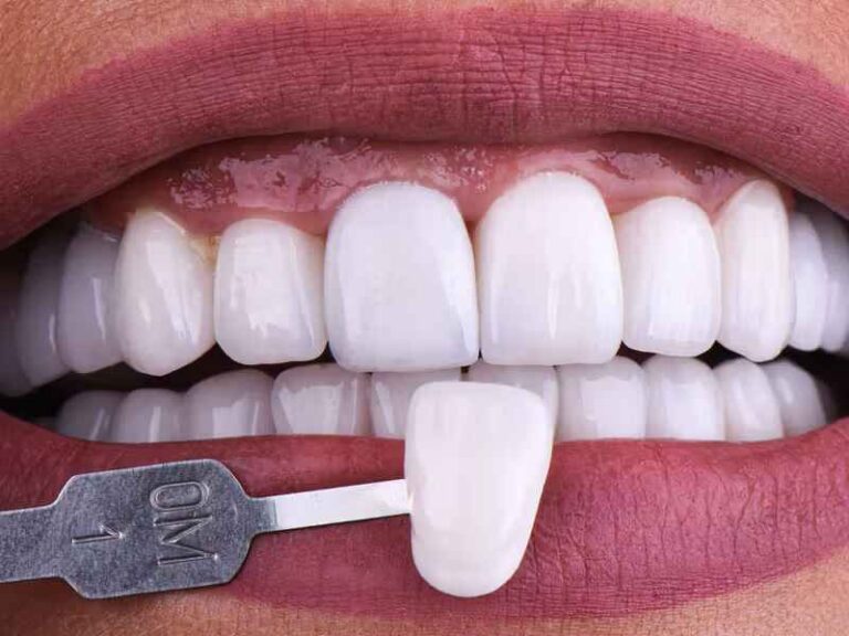 Veneer