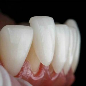 Perché E.max è spesso la scelta preferita per i restauri di un singolo dente anteriore