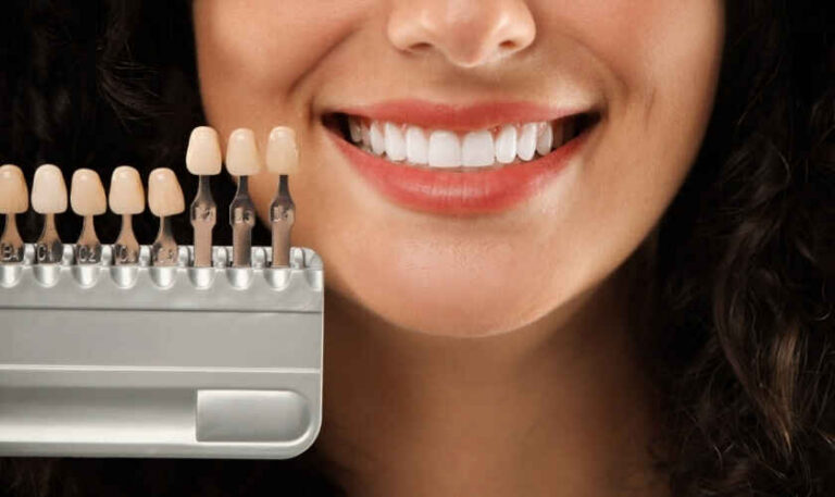 Why Feldspathic Veneers Still Lead in Premium Esthetic Cases